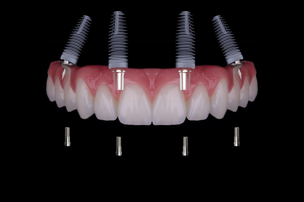 Will I Need A Bone Graft For The All On   Procedure?